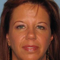 Eyelid Surgery Before & After Patient #11648