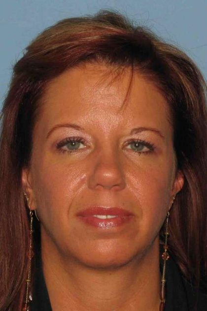 Eyelid Surgery Before & After Patient #11648