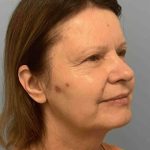 Eyelid Surgery Before & After Patient #11668