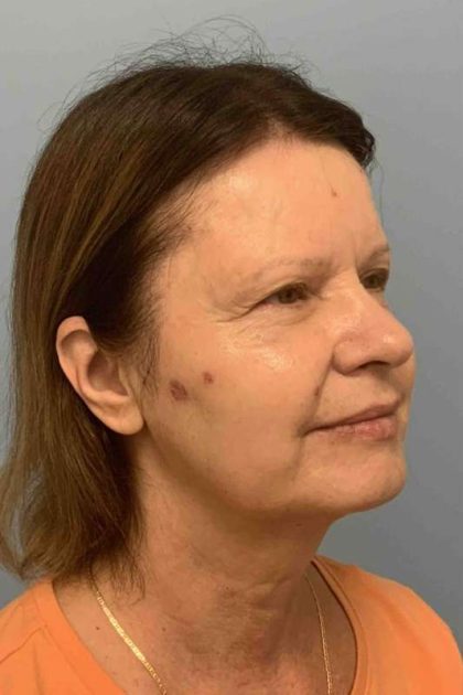 Eyelid Surgery Before & After Patient #11668