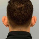 Ear Surgery Before & After Patient #11680