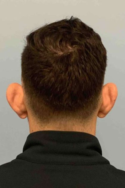 Ear Surgery Before & After Patient #11680