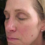Chemical Peels Before & After Patient #11701