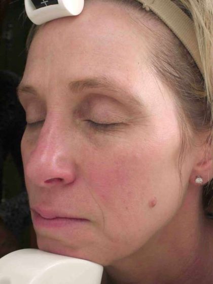 Chemical Peels Before & After Patient #11701