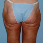 Buttocks Before & After Patient #11711