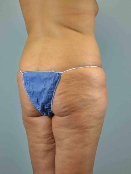 Buttocks Before & After Patient #11718
