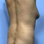Buttocks Before & After Patient #11728