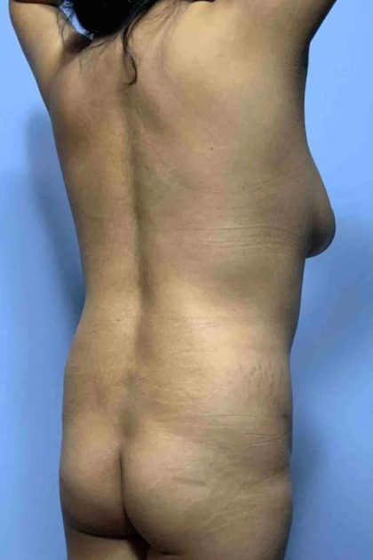 Buttocks Before & After Patient #11728