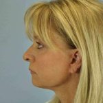 Brow Lift Before & After Patient #11756