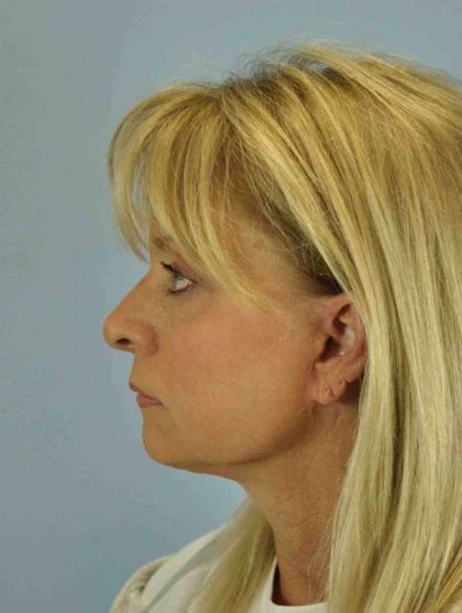 Brow Lift Before & After Patient #11756