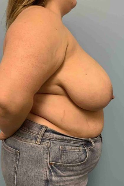 Breast Reduction Before & After Patient #11854