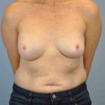 Breast Reconstruction Before & After Patient #11884