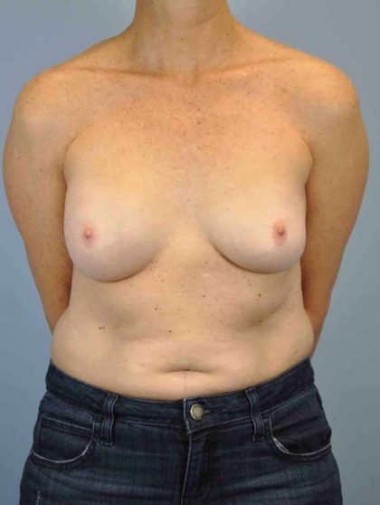Breast Reconstruction Before & After Patient #11884