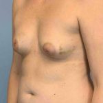 Breast Reconstruction Before & After Patient #11894