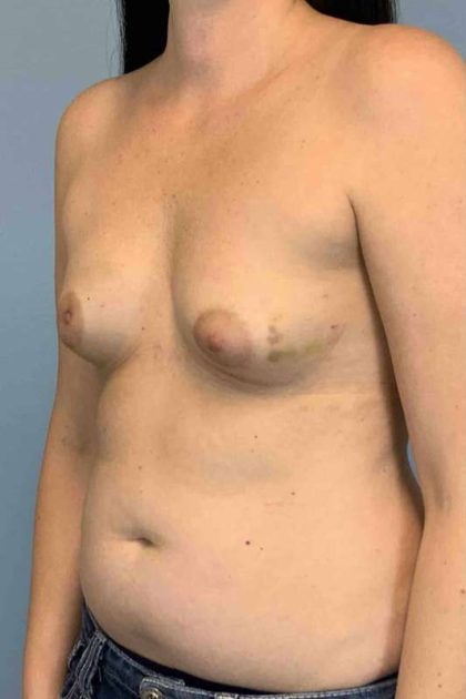 Breast Reconstruction Before & After Patient #11894