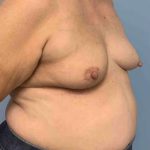 Breast Reconstruction Before & After Patient #11901