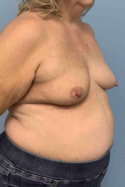 Breast Reconstruction Before & After Patient #11901