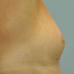 Breast Reconstruction Before & After Patient #11908