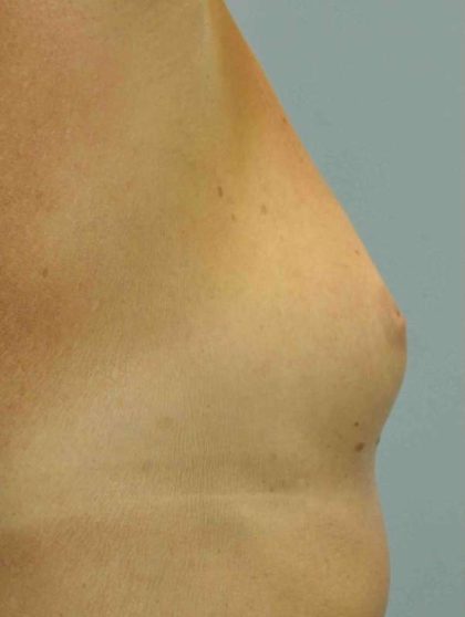 Breast Reconstruction Before & After Patient #11908