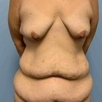 Breast Lift Before & After Patient #11926