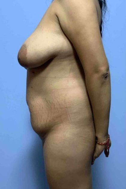 Breast Lift Before & After Patient #11945