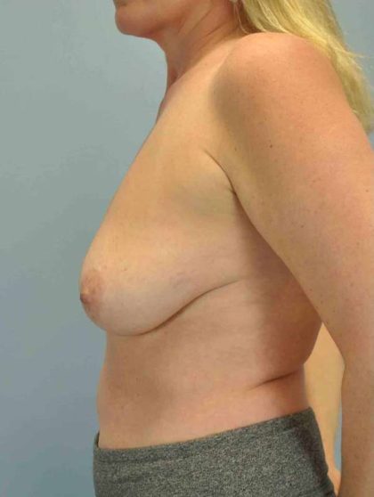 Breast Lift Before & After Patient #12021