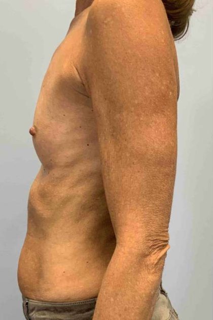 Breast Augmentation Before & After Patient #12049