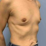 Breast Augmentation Before & After Patient #12056