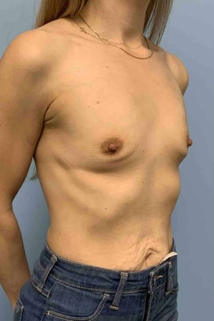 Breast Augmentation Before & After Patient #12056