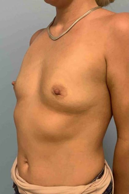 Breast Augmentation Before & After Patient #12063