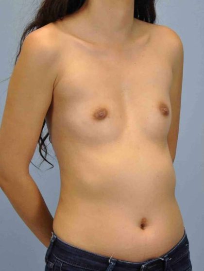 Breast Augmentation Before & After Patient #12077
