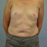 Breast Augmentation Before & After Patient #12082