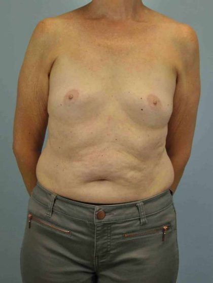 Breast Augmentation Before & After Patient #12082