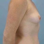 Breast Augmentation Before & After Patient #12089