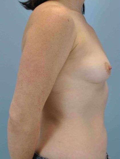 Breast Augmentation Before & After Patient #12089