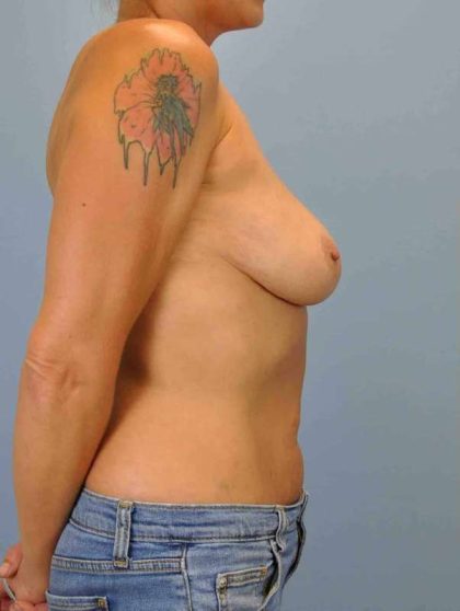 Breast Augmentation Before & After Patient #12101