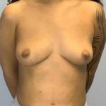 Breast Augmentation Before & After Patient #12113