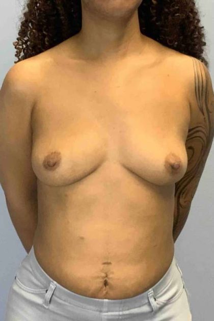 Breast Augmentation Before & After Patient #12113