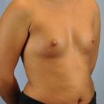 Breast Augmentation Before & After Patient #12120