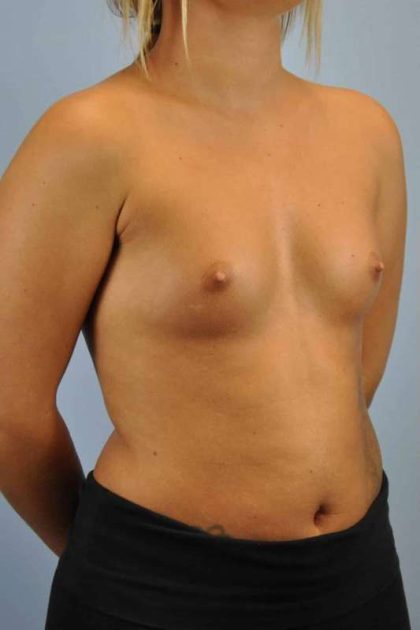 Breast Augmentation Before & After Patient #12120