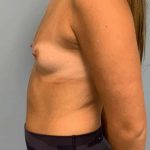 Breast Augmentation Before & After Patient #12127
