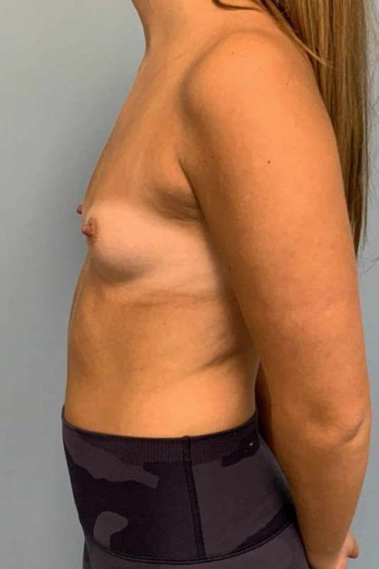 Breast Augmentation Before & After Patient #12127