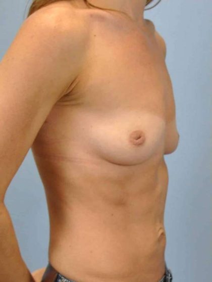 Breast Augmentation Before & After Patient #12143