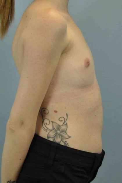 Breast Augmentation Before & After Patient #12157