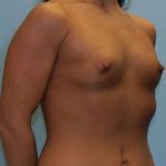 Breast Augmentation Before & After Patient #12164