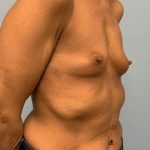 Breast Augmentation Before & After Patient #12171