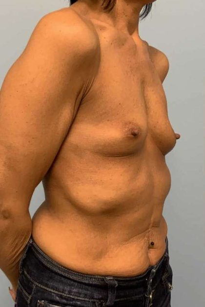 Breast Augmentation Before & After Patient #12171