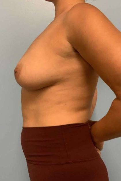Breast Augmentation Before & After Patient #12178