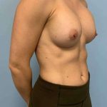 Breast Augmentation Before & After Patient #12206