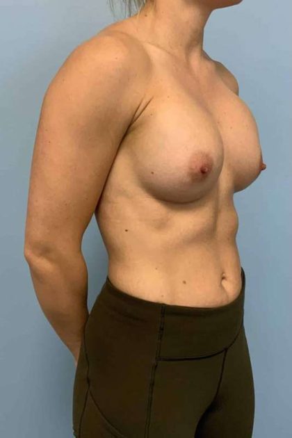 Breast Augmentation Before & After Patient #12206